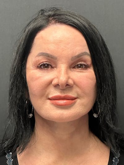 Facelift Before & After Gallery - Patient 636716 - Image 2