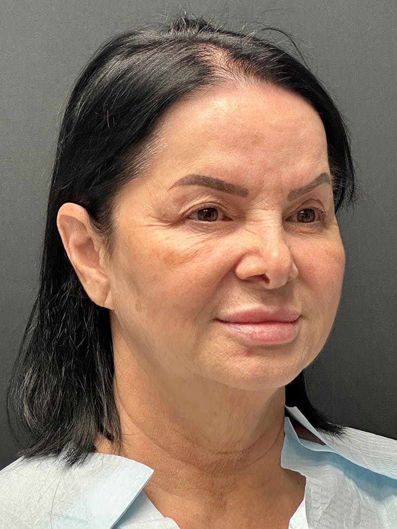 Facelift Before & After Gallery - Patient 636716 - Image 3