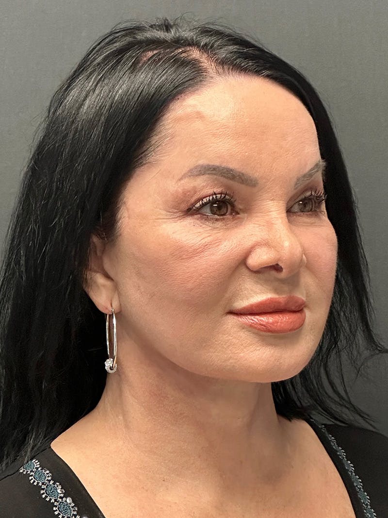 Facelift Before & After Gallery - Patient 636716 - Image 4
