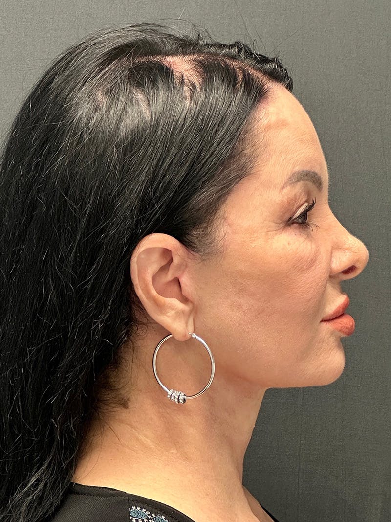 Neck Lift Before & After Gallery - Patient 394928 - Image 6