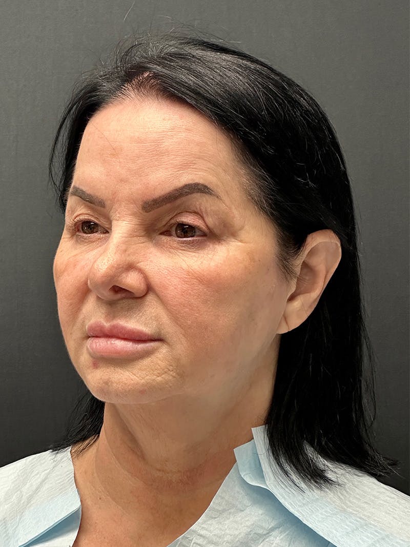 Blepharoplasty Before & After Gallery - Patient 271107 - Image 3