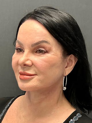 Blepharoplasty Before & After Gallery - Patient 271107 - Image 4