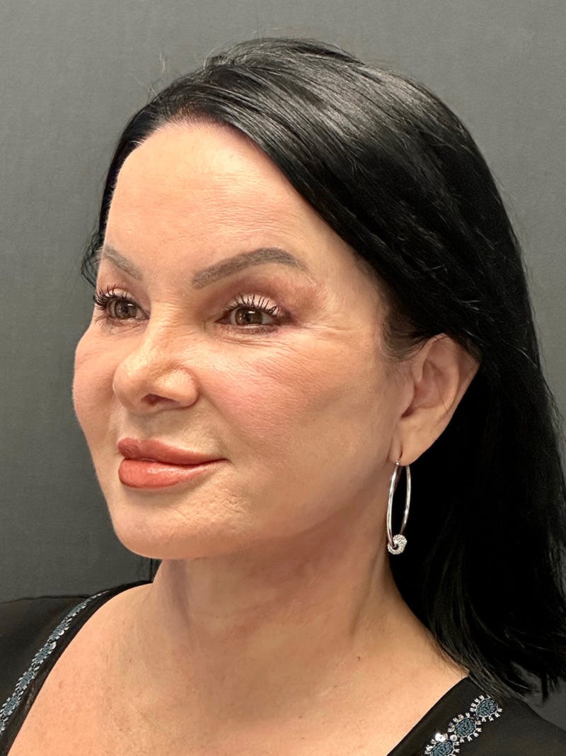 Blepharoplasty Before & After Gallery - Patient 271107 - Image 4