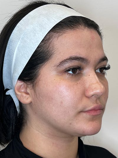Facial Balancing Before & After Gallery - Patient 345638 - Image 1