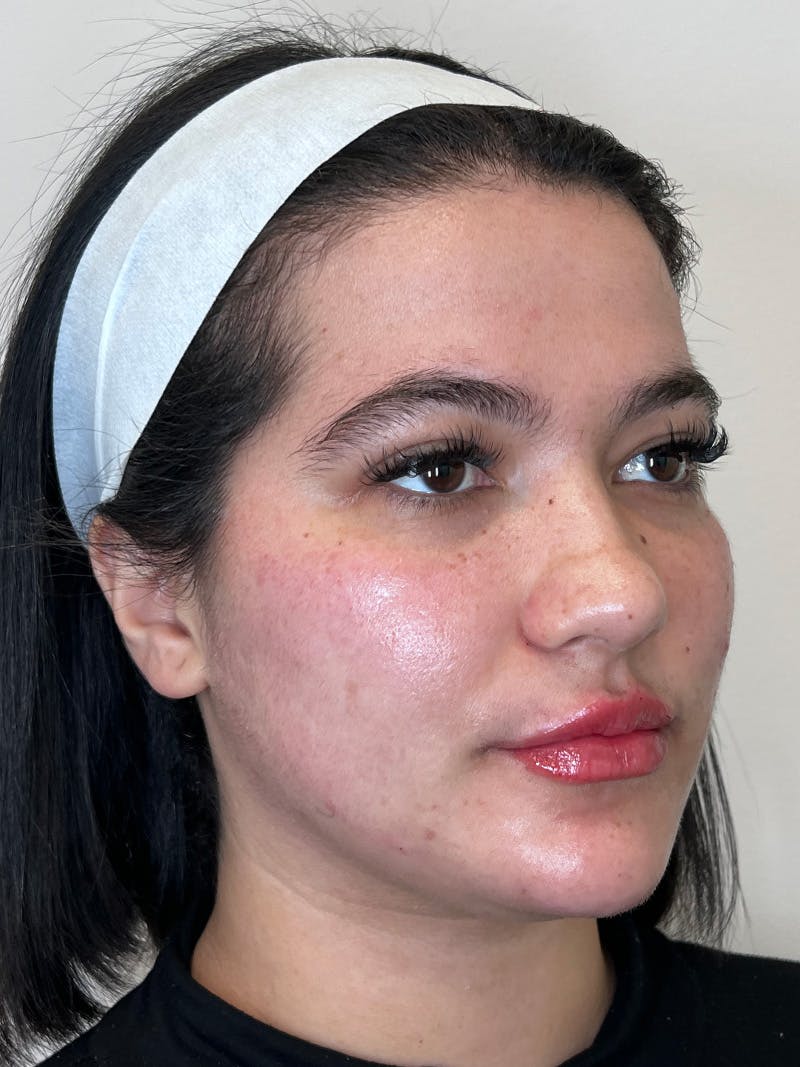 Facial Balancing Before & After Gallery - Patient 345638 - Image 2