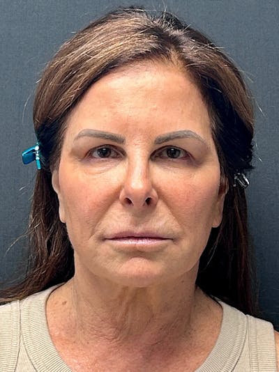 Facelift Before & After Gallery - Patient 125455 - Image 1