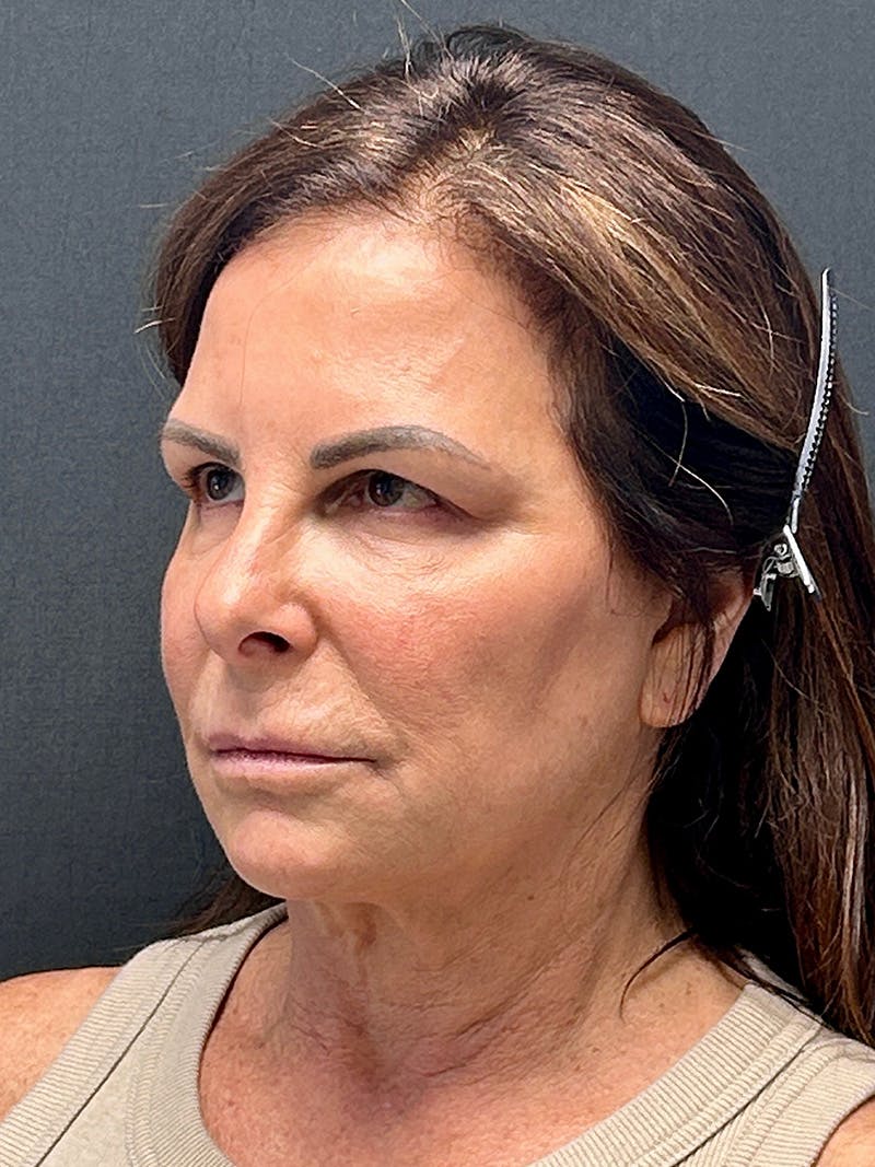 Facelift Before & After Gallery - Patient 125455 - Image 3