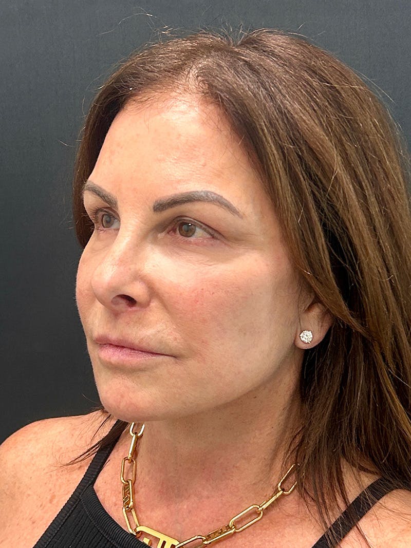 Facelift Before & After Gallery - Patient 125455 - Image 4