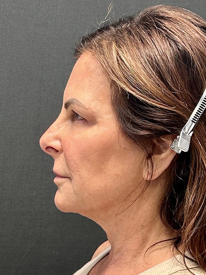 Facial Fat Grafting Before & After Gallery - Patient 391881 - Image 5