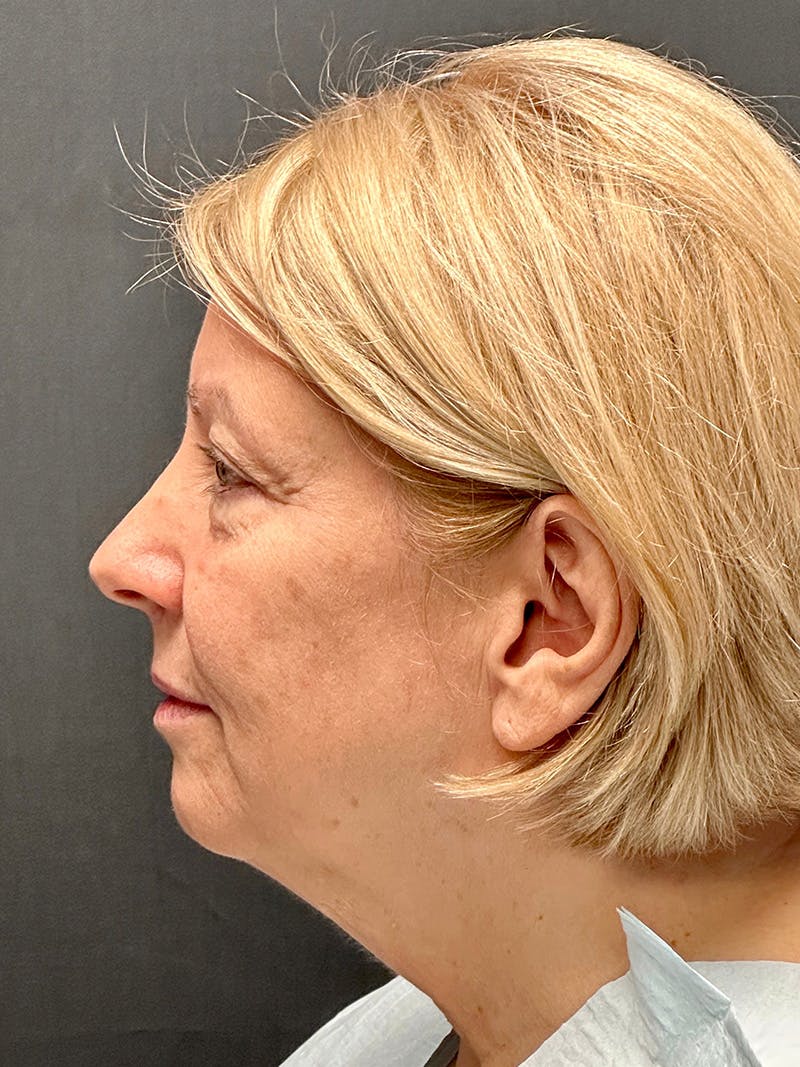 Facelift Before & After Gallery - Patient 251466 - Image 5