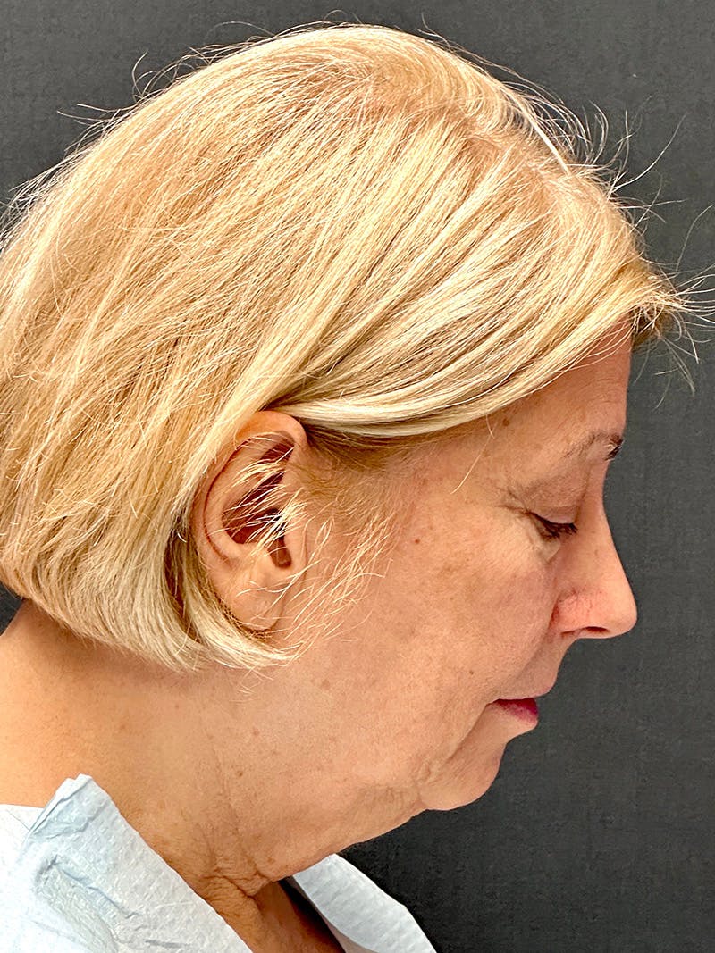 Facelift Before & After Gallery - Patient 251466 - Image 7