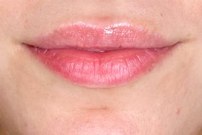 Lip Filler Before & After Gallery - Patient 483609 - Image 1