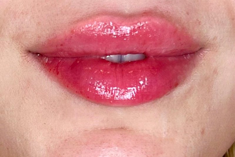 Lip Filler Before & After Gallery - Patient 483609 - Image 2