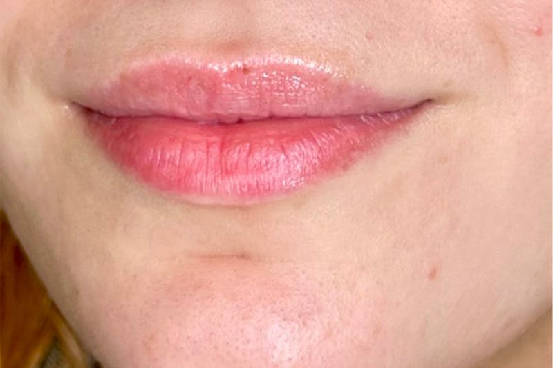 Lip Filler Before & After Gallery - Patient 483609 - Image 3