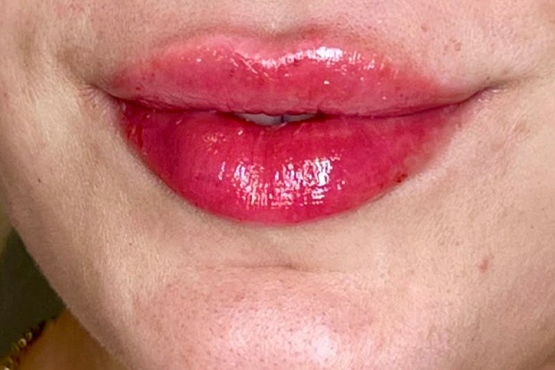 Lip Filler Before & After Gallery - Patient 483609 - Image 4