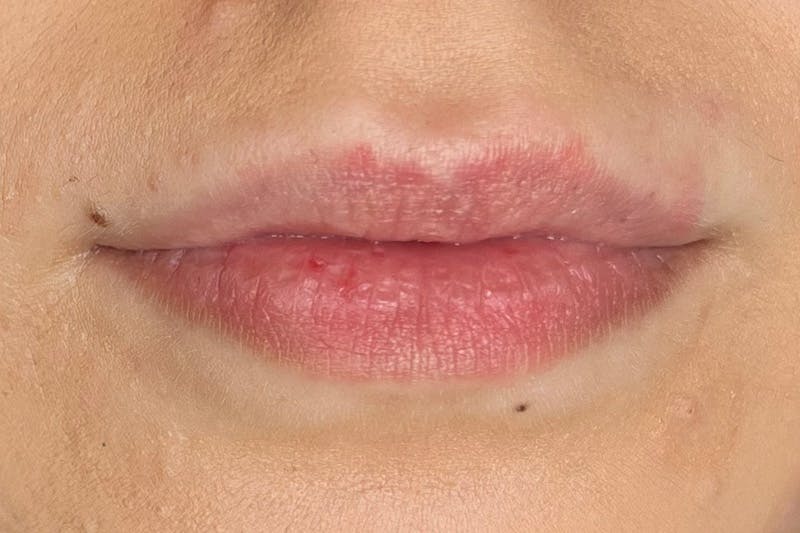 Lip Filler Before & After Gallery - Patient 357529 - Image 1