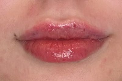 Lip Filler Before & After Gallery - Patient 357529 - Image 2