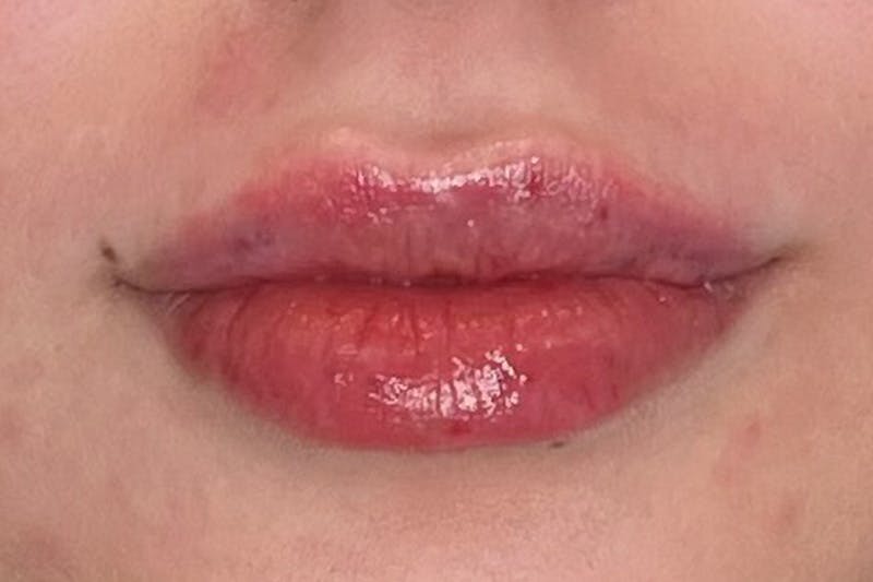 Lip Filler Before & After Gallery - Patient 357529 - Image 2