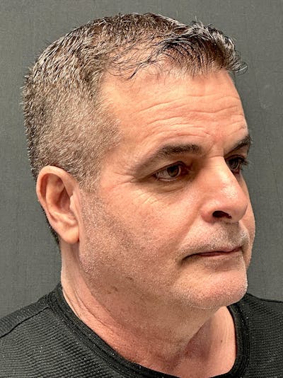 Neck Lift Before & After Gallery - Patient 265658 - Image 1