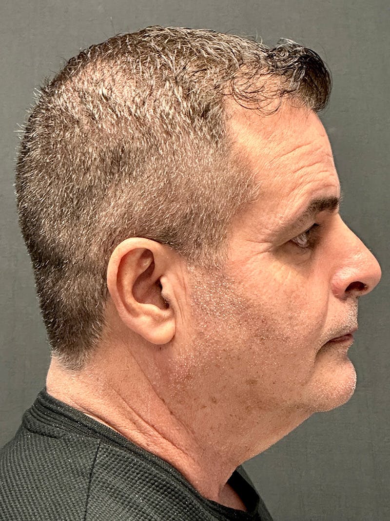 Neck Lift Before & After Gallery - Patient 265658 - Image 5