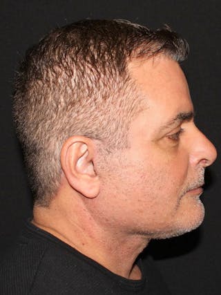 Blepharoplasty Before & After Gallery - Patient 221689 - Image 6