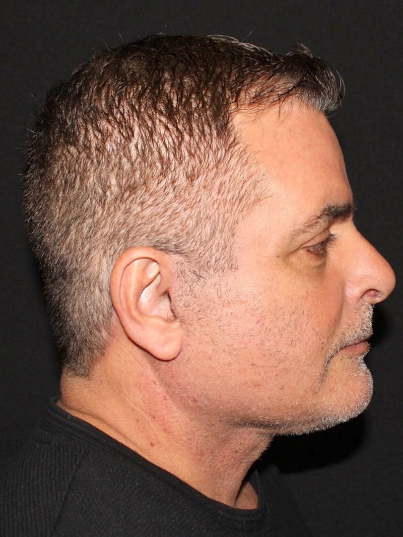 Neck Lift Before & After Gallery - Patient 265658 - Image 6