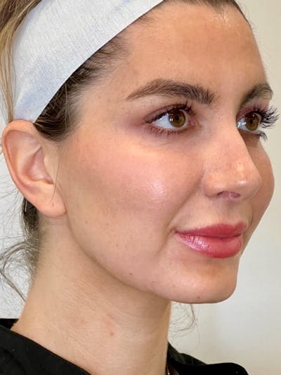 Nefertiti Neck Lift Before & After Gallery - Patient 188230 - Image 2