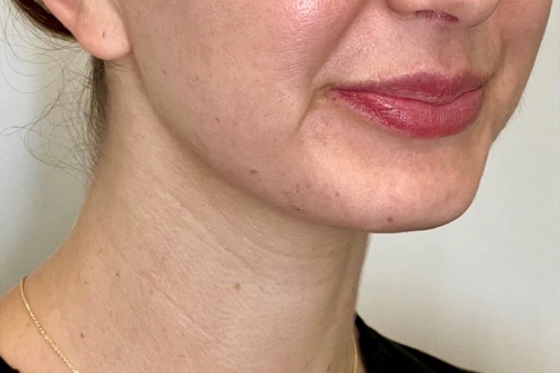 BOTOX Before & After Gallery - Patient 330985 - Image 3