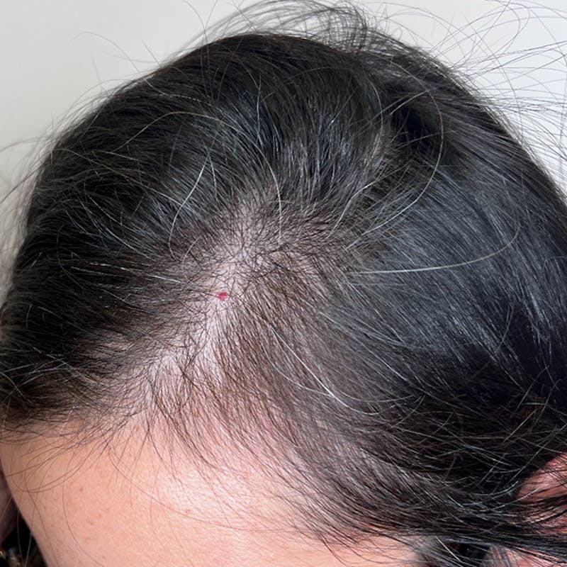 Hair Restoration Before & After Gallery - Patient 857335 - Image 1