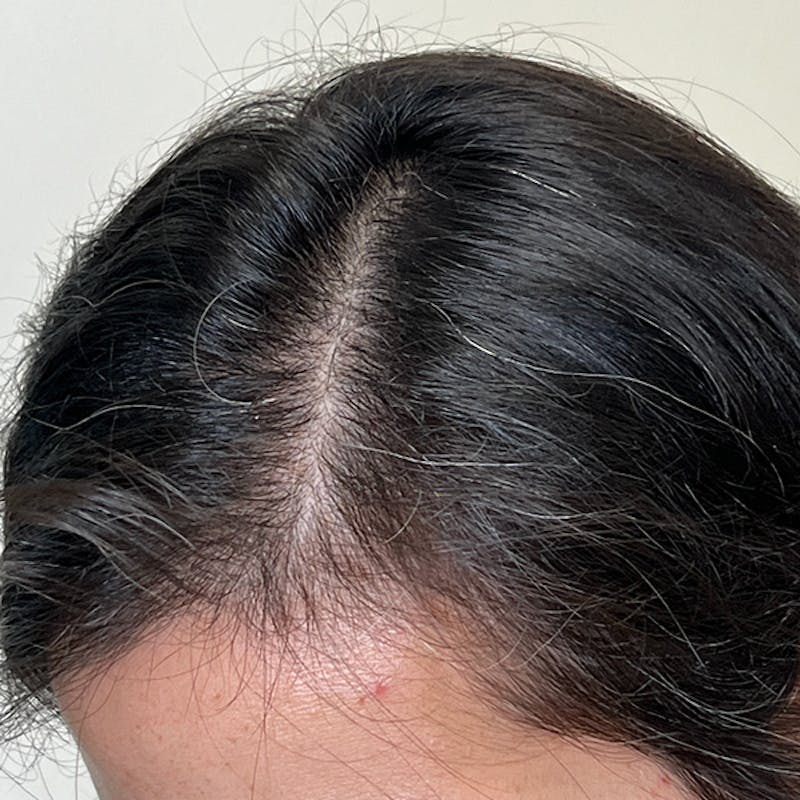 Hair Restoration Before & After Gallery - Patient 857335 - Image 2