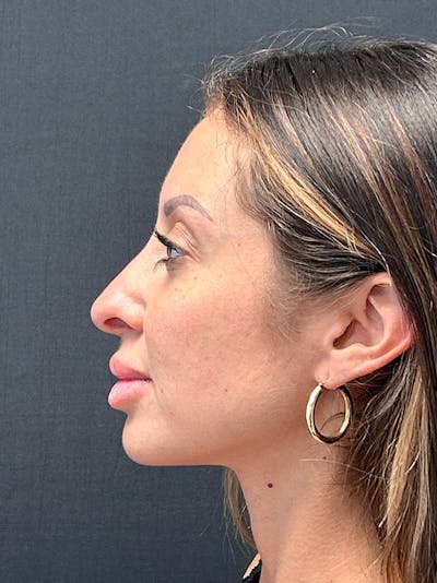 Primary Rhinoplasty Before & After Gallery - Patient 419135 - Image 1