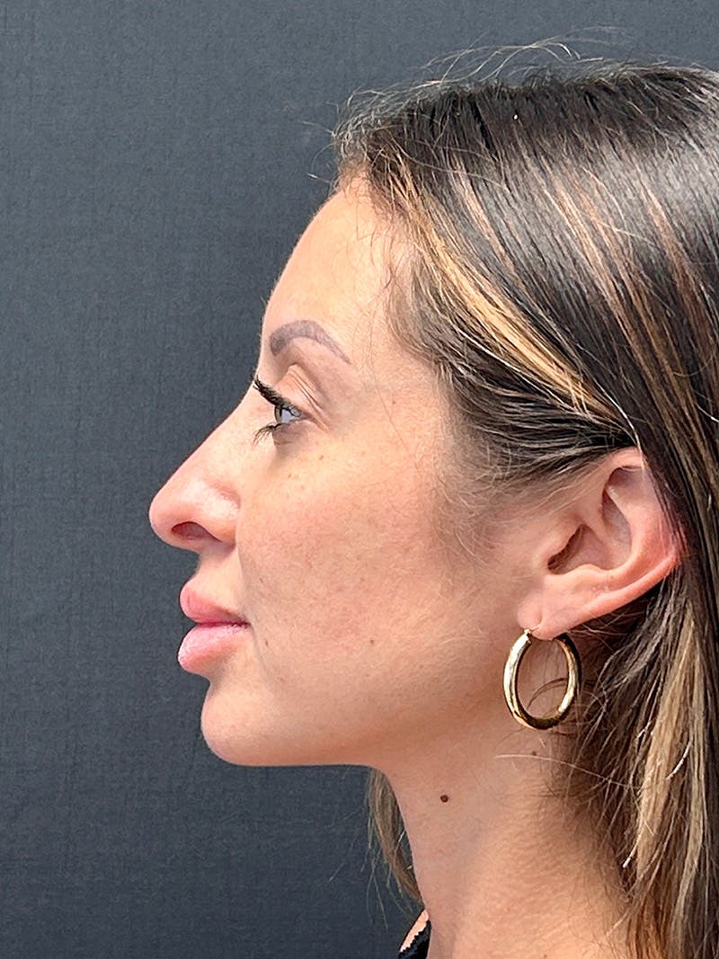 Primary Rhinoplasty Before & After Gallery - Patient 419135 - Image 3