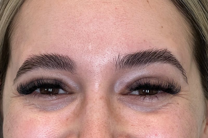BOTOX Before & After Gallery - Patient 377796 - Image 3