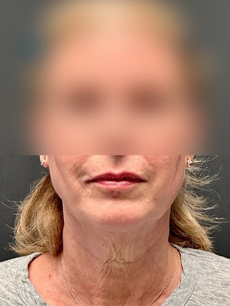 Neck Lift Before & After Gallery - Patient 333673 - Image 1