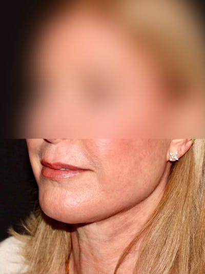 Neck Lift Before & After Gallery - Patient 333673 - Image 2