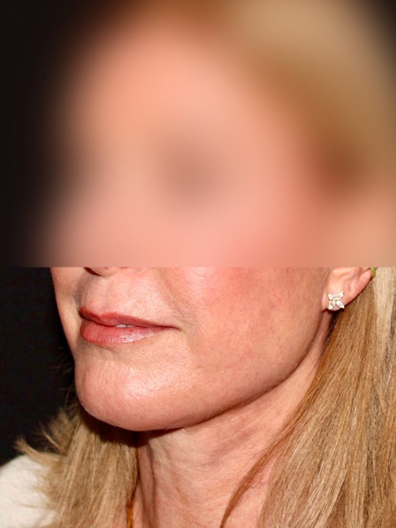 Facial Fat Grafting Before & After Gallery - Patient 211099 - Image 4
