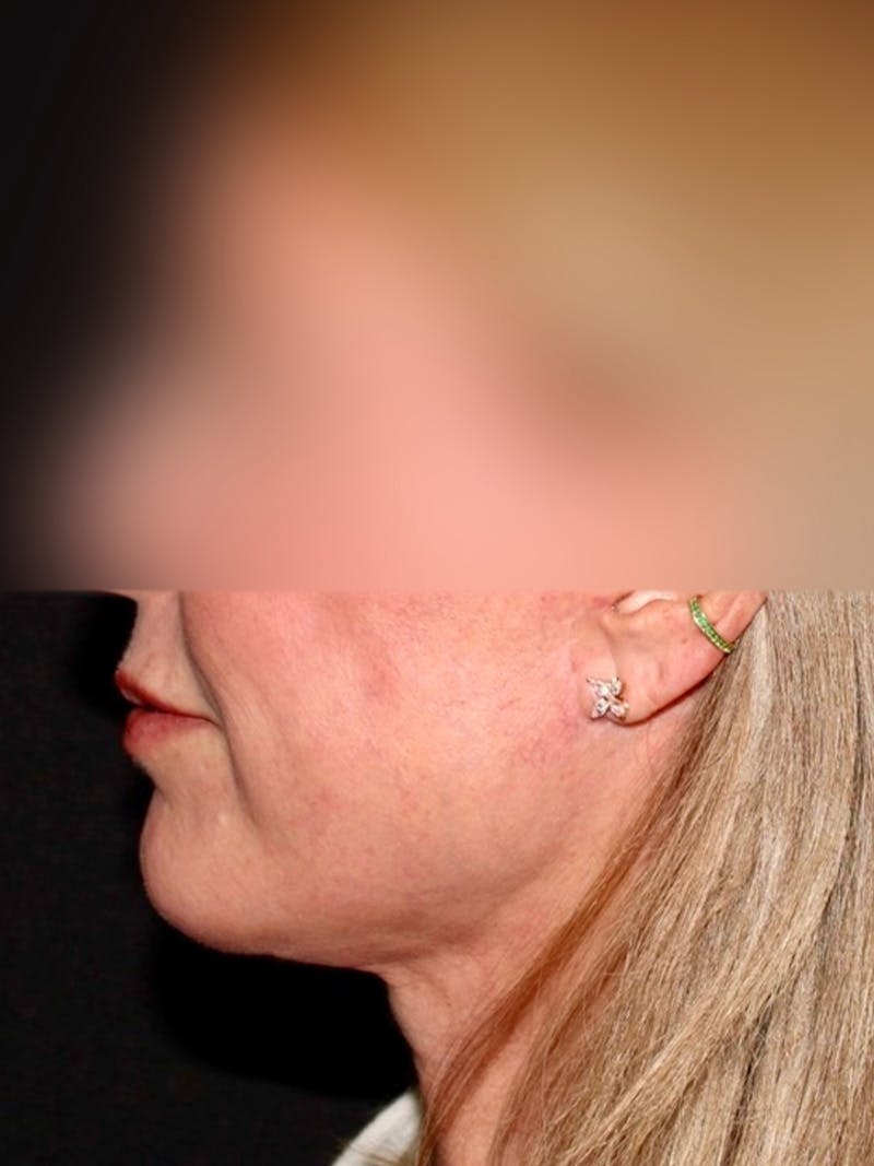Facial Fat Grafting Before & After Gallery - Patient 211099 - Image 6