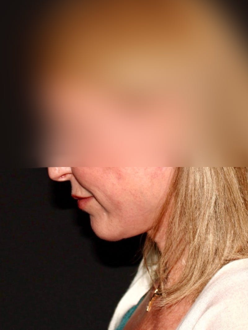 Facial Fat Grafting Before & After Gallery - Patient 211099 - Image 8