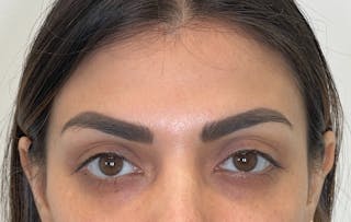 Dysport Before & After Gallery - Patient 693075 - Image 6