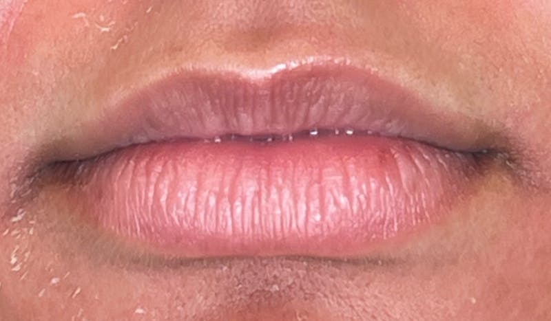 Lip Filler Before & After Gallery - Patient 215714 - Image 1