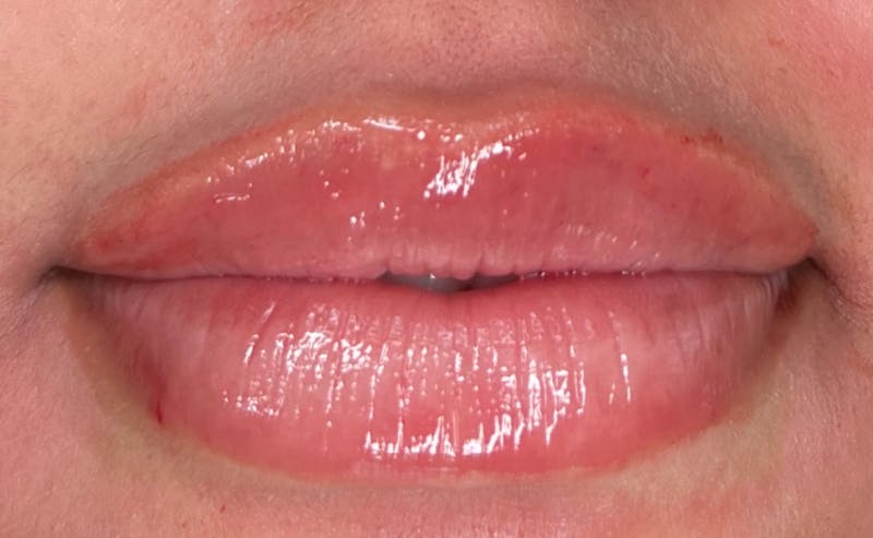 Lip Filler Before & After Gallery - Patient 215714 - Image 2