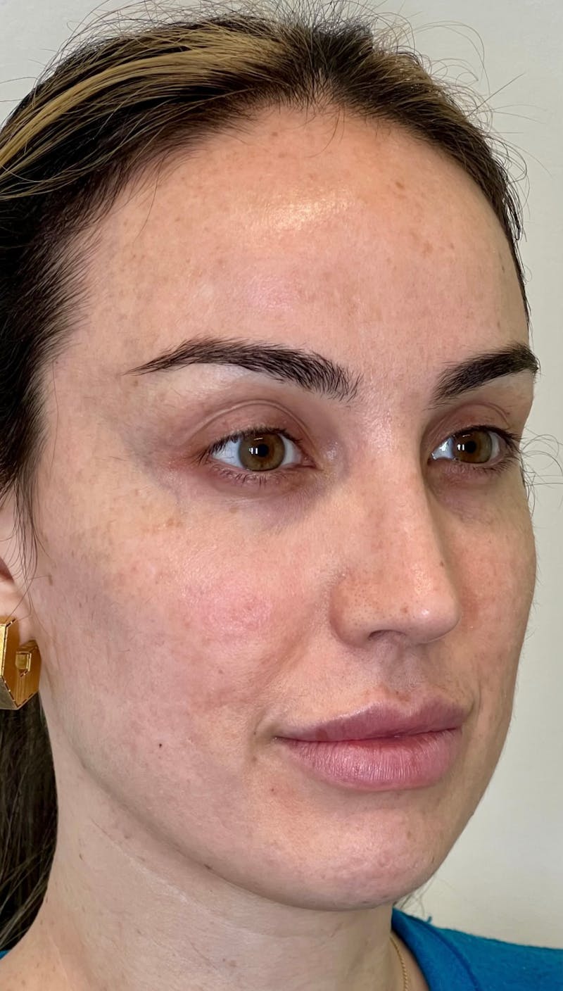 Facial Filler Before & After Gallery - Patient 288306 - Image 2