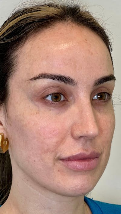 Facial Filler Before & After Gallery - Patient 288306 - Image 2