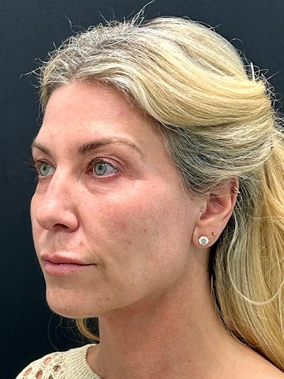 Neck Lift Before & After Gallery - Patient 367525 - Image 1