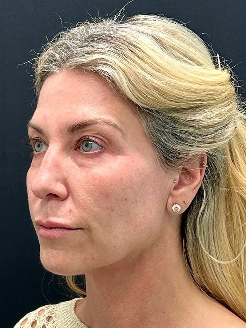 Facelift Before & After Gallery - Patient 194590 - Image 3