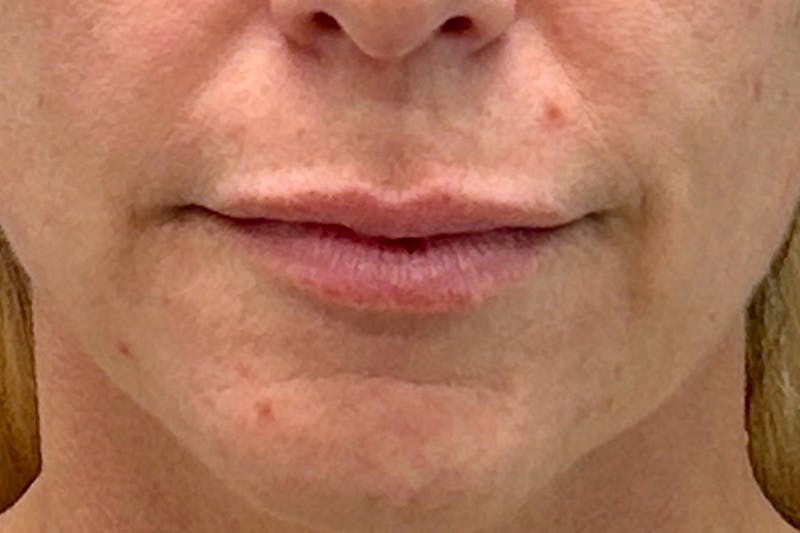 Lip Lift Before & After Gallery - Patient 770268 - Image 1