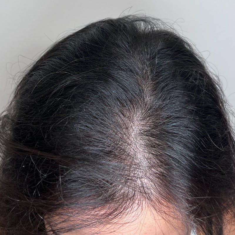 Hair Restoration Before & After Gallery - Patient 167332 - Image 1