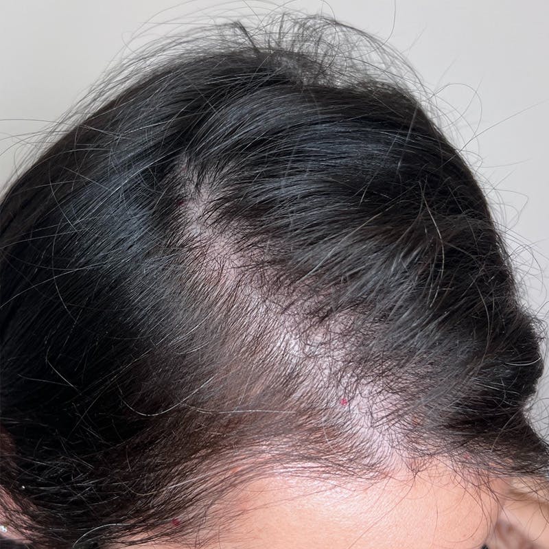 Hair Restoration Before & After Gallery - Patient 167332 - Image 3