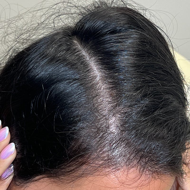 Hair Restoration Before & After Gallery - Patient 167332 - Image 4