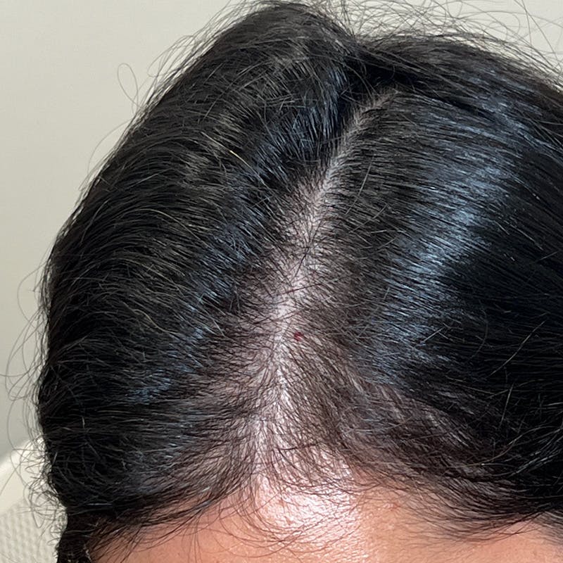 Hair Restoration Before & After Gallery - Patient 167332 - Image 6